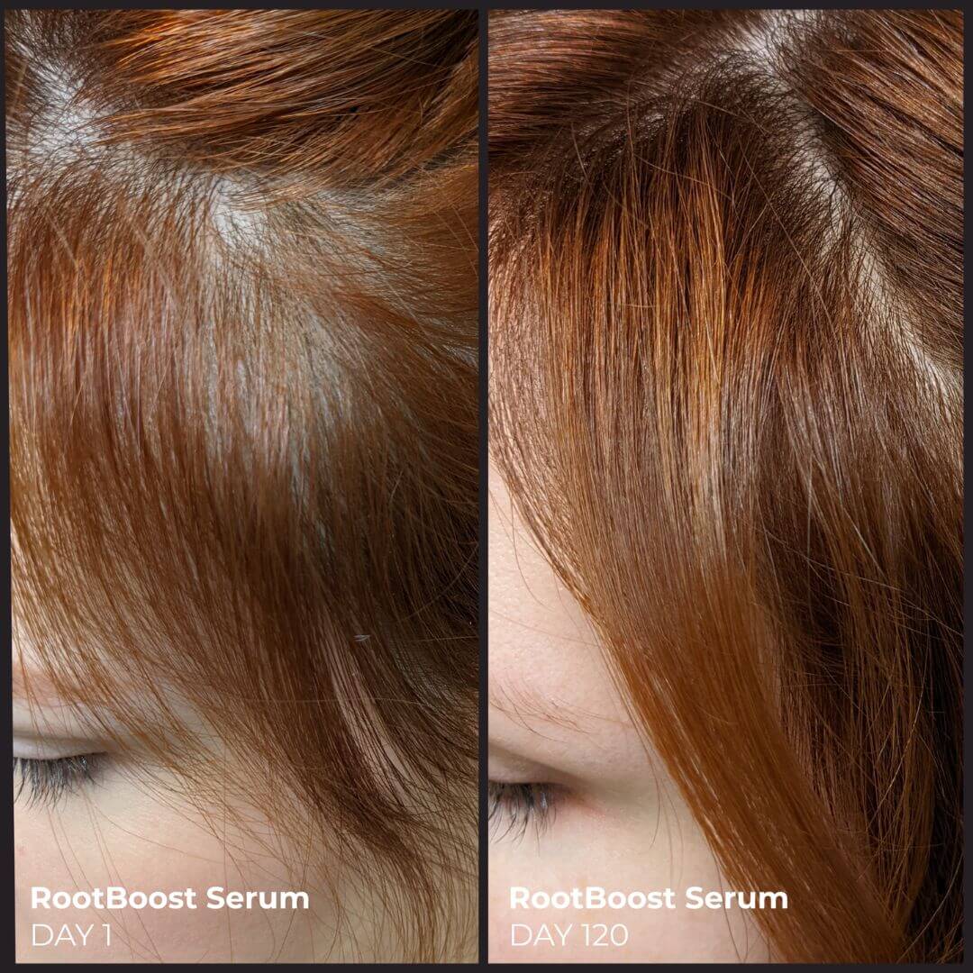 Before and after comparison of hair growth using RootBoost Serum on a person with red hair.
