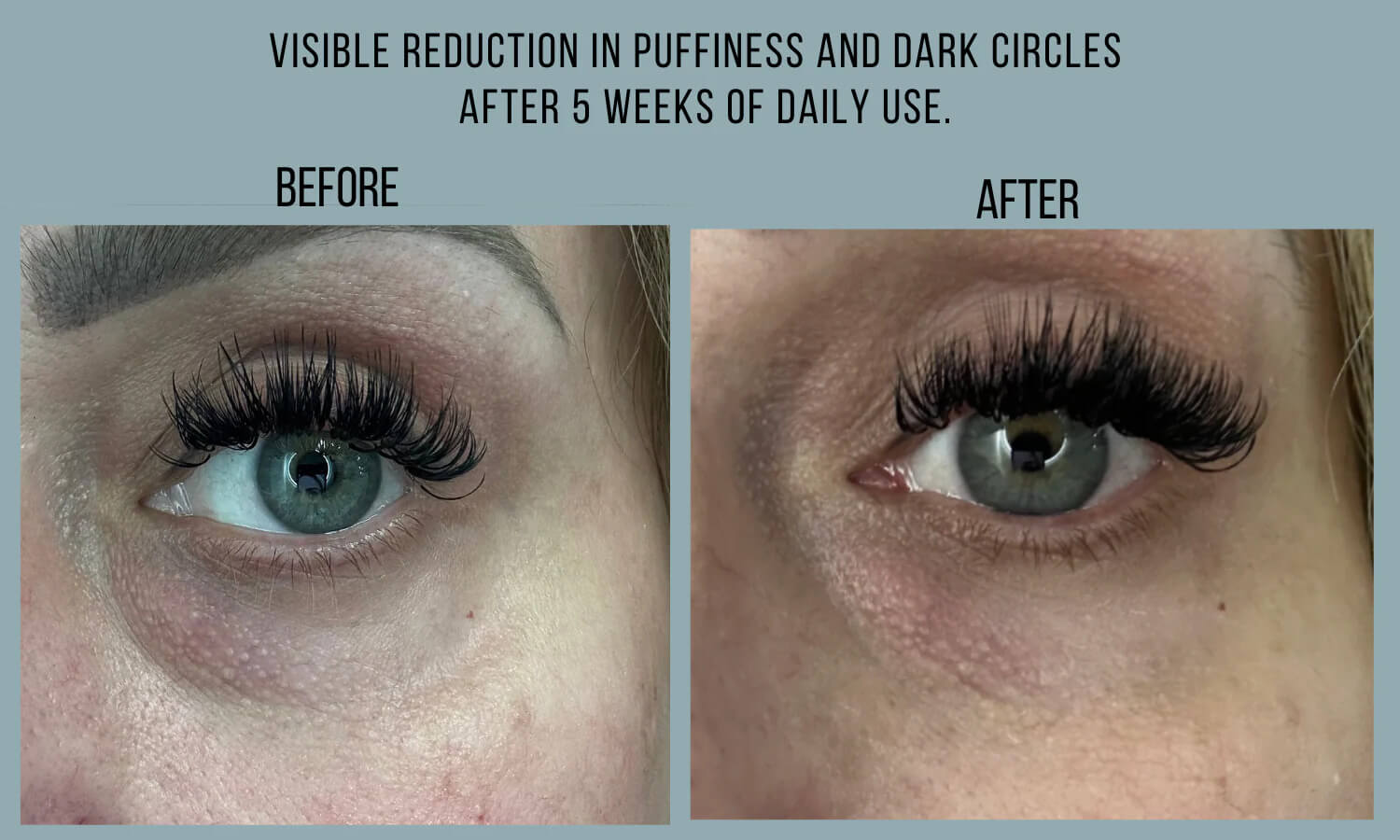 Before and after comparison of eye area with visible reduction in puffiness and dark circles.