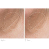 Le Prunier Plumbody Results on wrinkles at 12 weeks