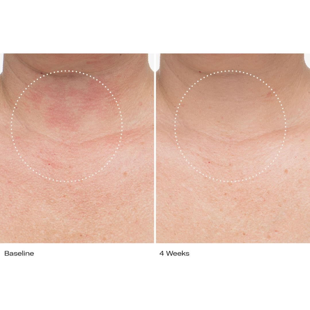 Le Prunier Plumbody results at 4 weeks